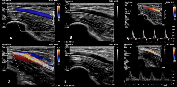 ULTRASONIDO DOPPLER