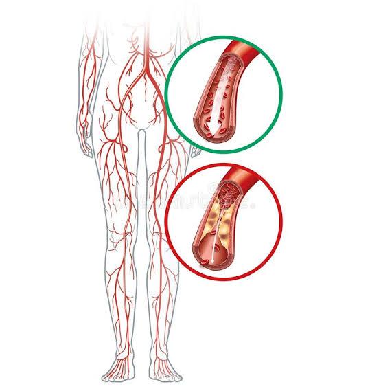 ISQUEMIA ARTERIAL AGUDA DE LOS MIEMBROS INFERIORES, SIGNOS DUROS Y SIGNOS BLANDOS DE LESIÓN VASCULAR